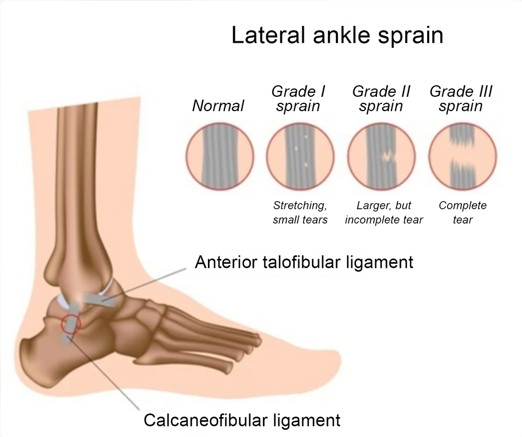 Managing ankle sprains and chronic ankle instability with bracing