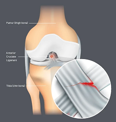 What are ACL Injuries?